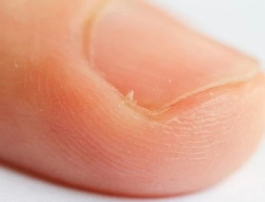 Παρωνυχίδα: Πώς την αφαιρούμε χωρίς πόνο και επιπλέον τραυματισμό